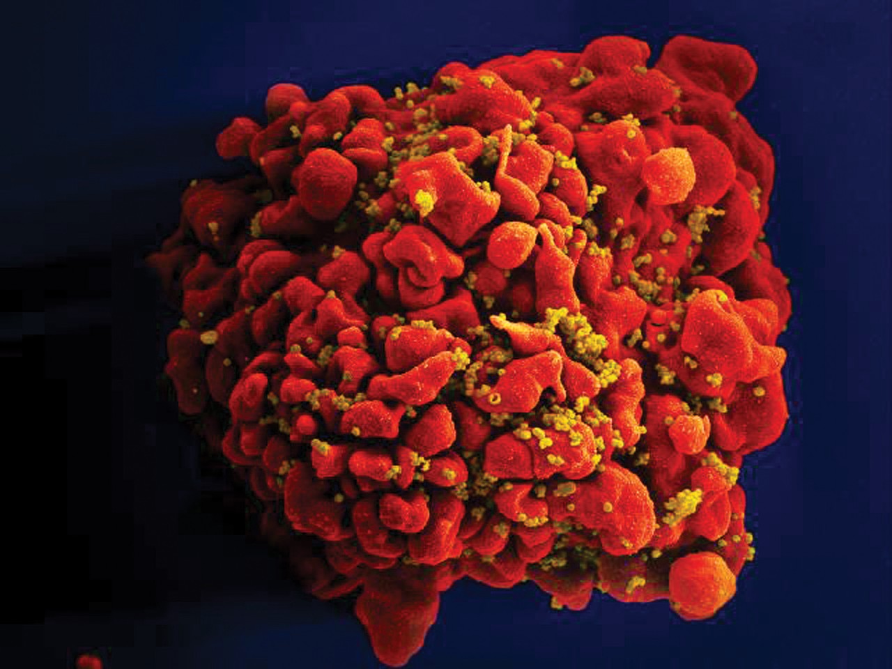 HIV Not As Infectious Soon After Transmission As Thought