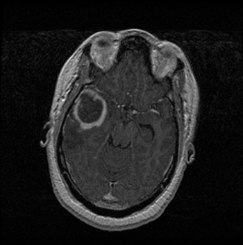 glioblastoma-brain-scan-350px